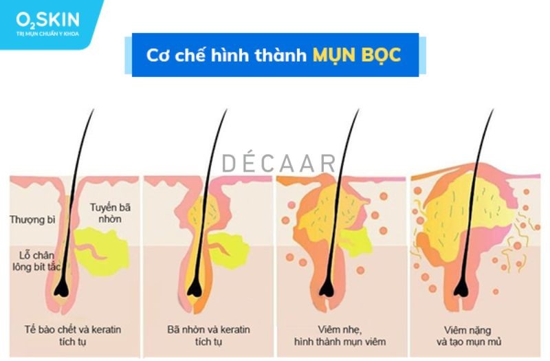 nguyên nhân mụn trứng cá bọc